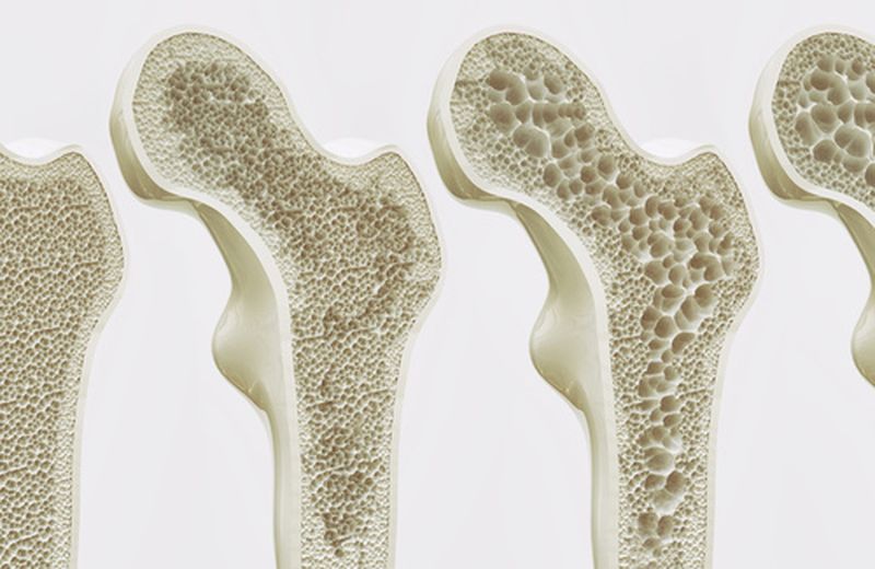 Featured image for “Che cos’è l’Osteoporosi?”