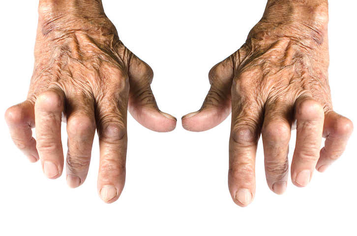 Featured image for “Artrite reumatoide”